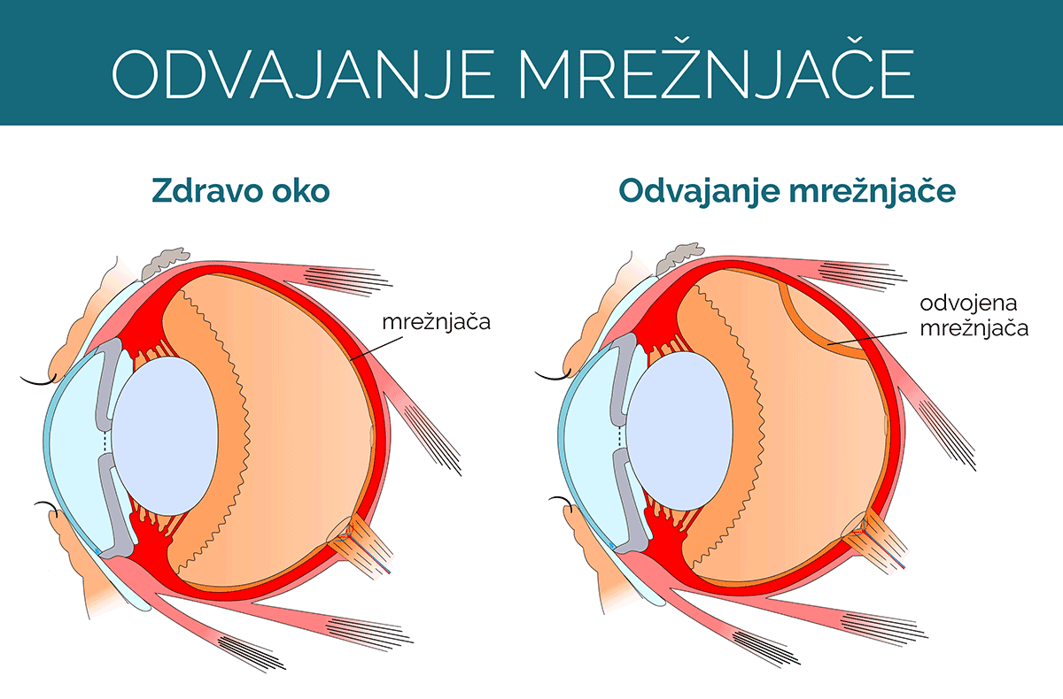 bljeskovi u očima i odvajanje mrežnjače