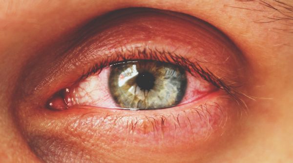 Crveno oko može da ukazuje na konjunktivitis