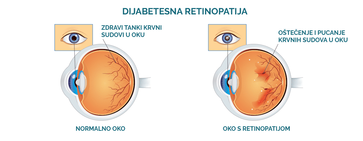 Infografika: dijabetes i dijabetesna retinopatija