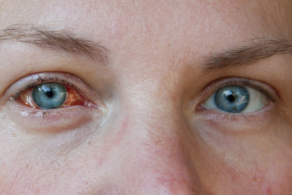 keratitis