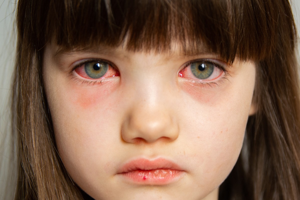 Konjunktivitis kod dece