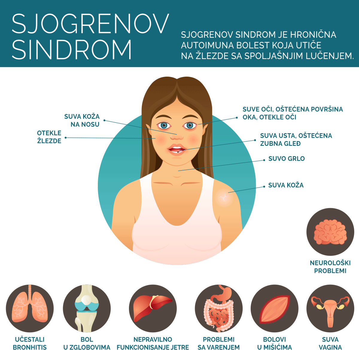 sjogrenov sindrom i simptomi
