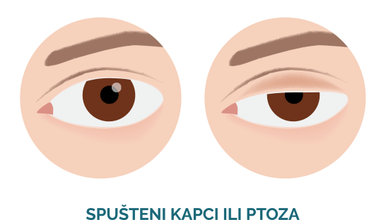 spušteni kapci ili ptoza: zdravo oko in oko s spuštenim kapakom