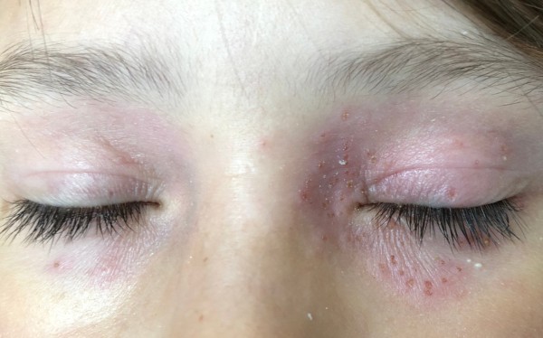 Periokularni dermatitis i svrab kapaka