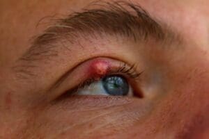 Izlečite čmičak na kapku i sprečite da se ponovo javi